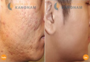 Trị sẹo lõm an toàn, hiệu quả tại TMV Kangnam1