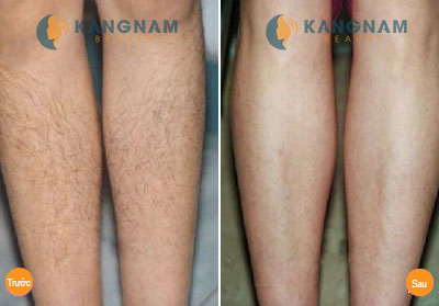 Triệt lông chân vĩnh viễn có hại đến da không ?