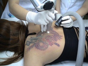 Xóa hình xăm bằng laser và những "điểm cộng" làm nên thương hiệu 2