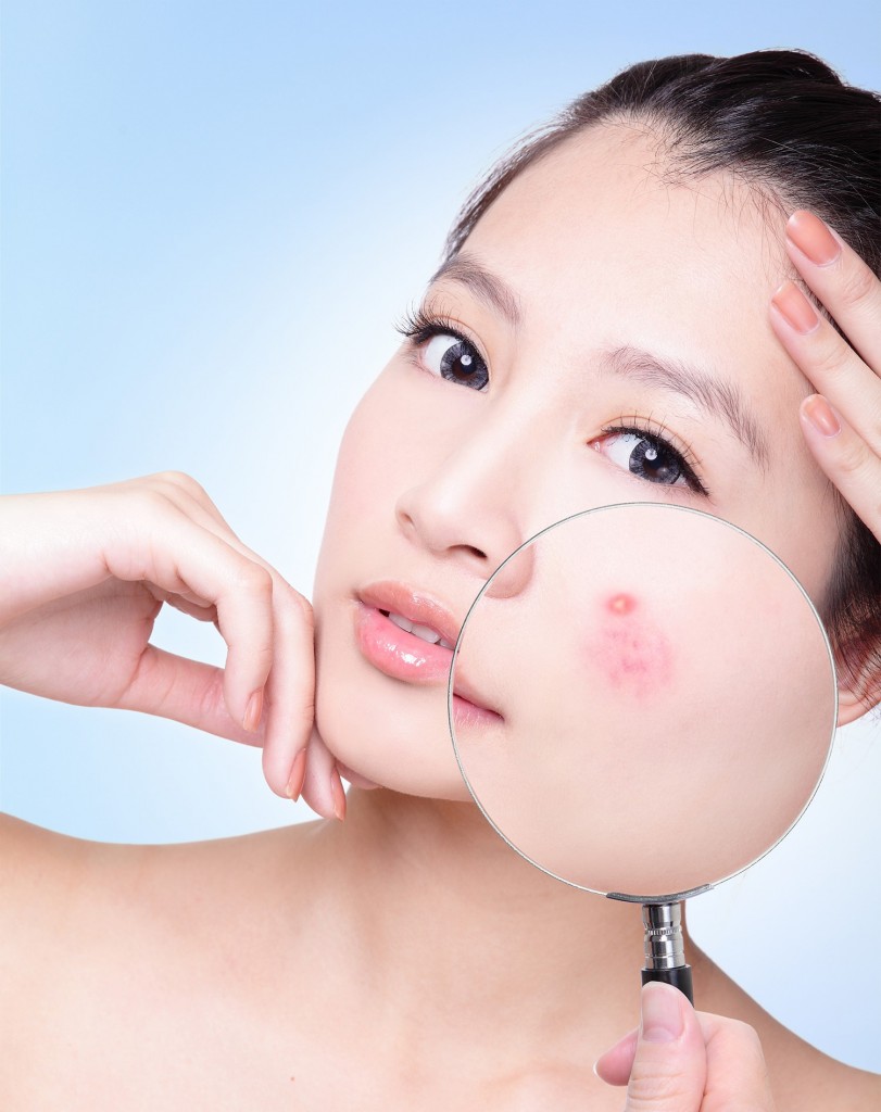 Cách trị sẹo thâm sau mụn hiệu quả nhất 2015