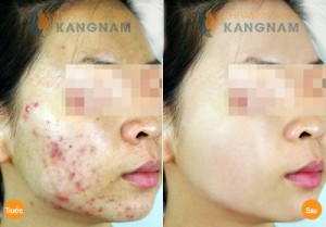 Đâu là công nghệ trị mụn hiệu quả nhất hiện nay? 3
