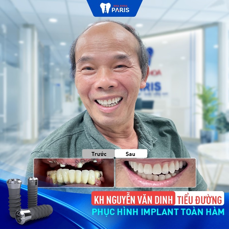 Trồng răng toàn hàm tại paris cho khách hàng