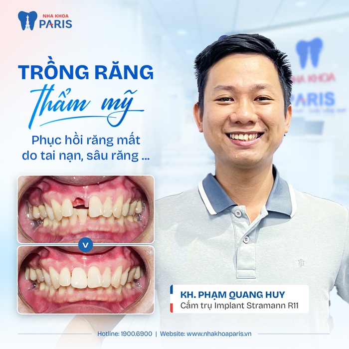 Trồng răng thẩm mỹ an toàn tại Paris Hà Nội