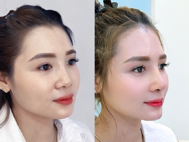 Hình ảnh thực tế khách hàng thay đổi diện mạo sau khi làm đẹp tại đơn vị uy tín.